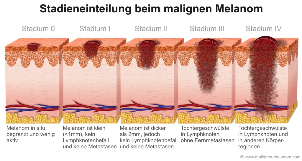 Malignes Melanom Stadien