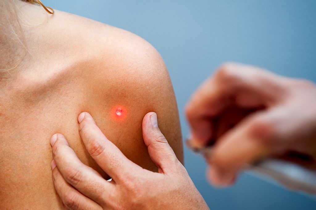 Melanomrisiko durch den Einfluss der UV-Strahlen