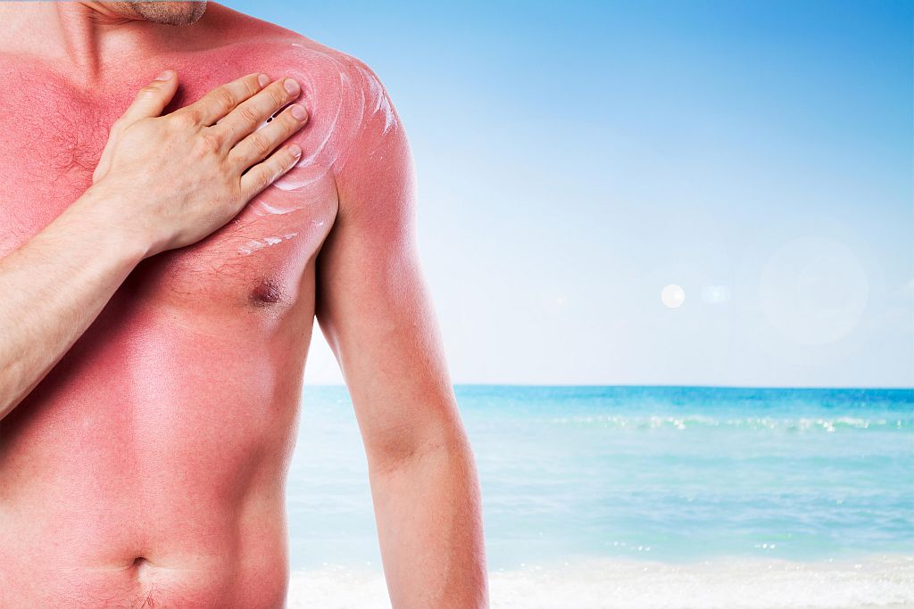 Melanomrisiko Sonnenbrand